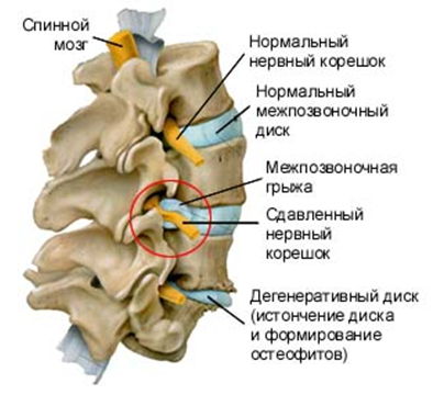 Людей с остеохондрозом верхнего отдела позвоночника часто беспокоит головная боль