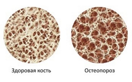  При остеопорозе кости таза становятся хрупкими