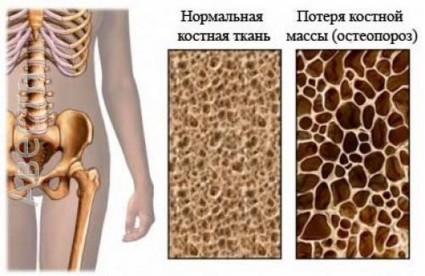 Нормальная костная ткань и пораженная остеопорозом