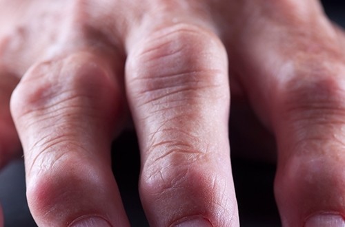 Фаланги пальцев, пораженные болезнью