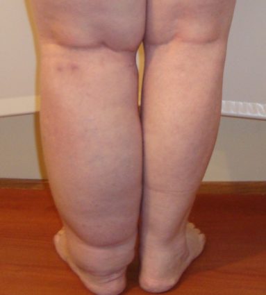 Отек голеностопного сустава появляется после некоторых травм