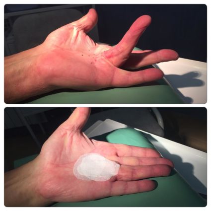 Болезнь Нотта - патология связок и сухожилий пальцев рук