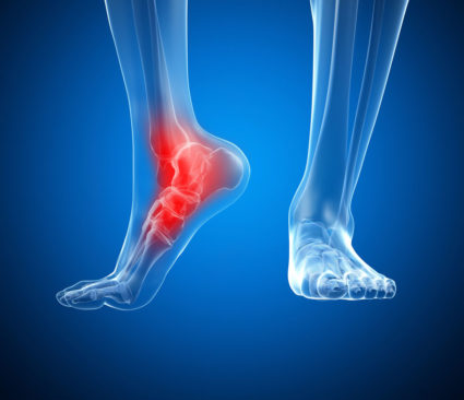 Болит нога сзади - может быть воспаление сухожилия