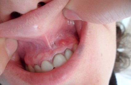  При наличии кариеса зуба, у больного может развиться остеомиелит