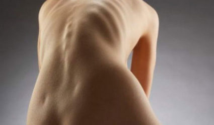 Симметричное упражнение при сколиозе имеет разное значение для мышц спины