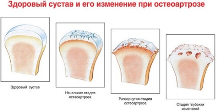 Здоровый сустав и его изменения при остеоарторе