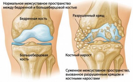 Пораженное коленный сустав