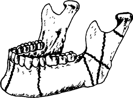 Единственной мобильной костью черепа именно является нижняя челюсть
