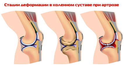 Артроз колена стадии