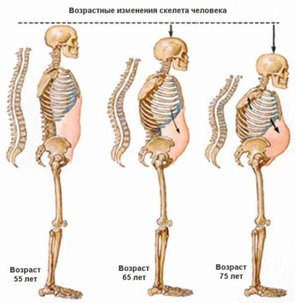 Возрастные изменения скелета человека 
