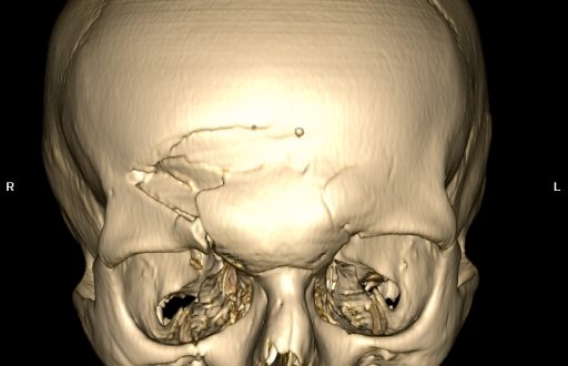 Травма черепа - опасна травма