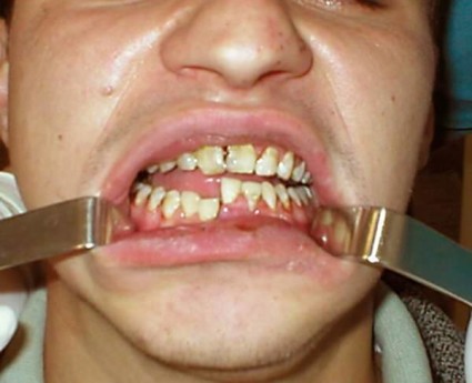 Признаки перелома нижней челюсти: сильные боли, шатание зубов, изменение прикуса