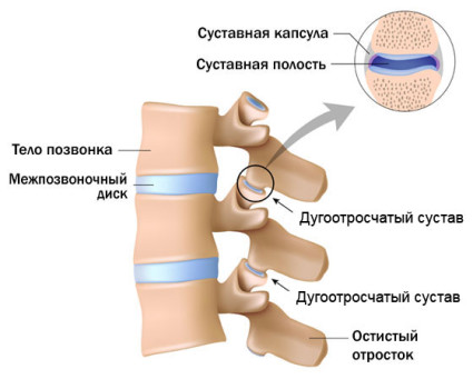 Источником болей в спине может быть такое заболевание, как артроз дугоотросчатых суставов позвоночник