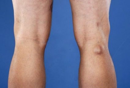 Киста коленного сустава – это доброкачественная опухоль