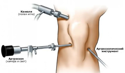 Артроскопия колена сводит к минимуму боли сустава