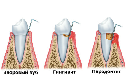 Процесс разрушения зуба при пародонтите