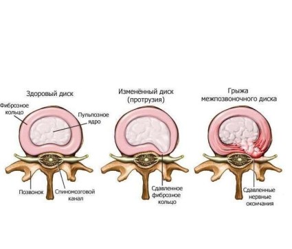 Протрузия поясничного отдела позвоночника часто проявляется в виде осложнения после остеохондроза