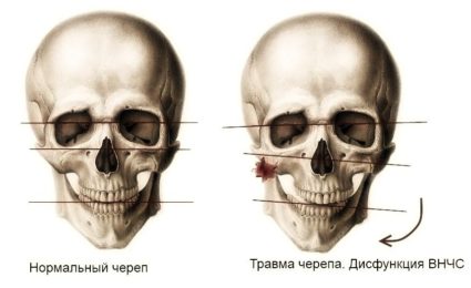 Чтобы подтвердить, опровергнуть перелом любого участка нижней челюсти, есть свои симптомы