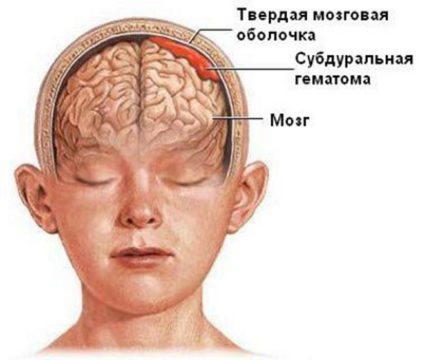 Симптомы ушиба головного мозга различаются в зависимости от тяжести травмы