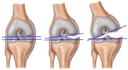 В коленном суставе человека имеется два мениска