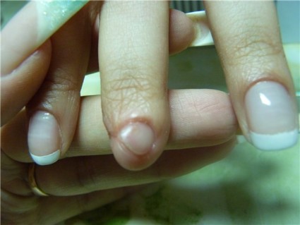 Ушиб ногтя – это тот же ушиб пальца, только происходит он ближе к ногтевой пластине