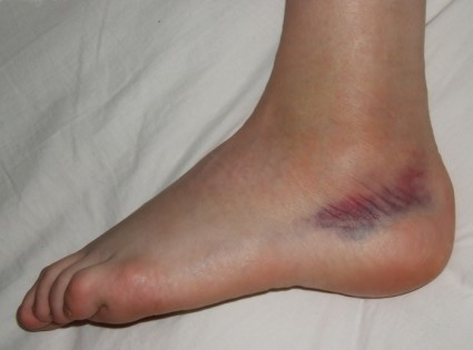 Часто возникает травмирование при падении на согнутые ноги