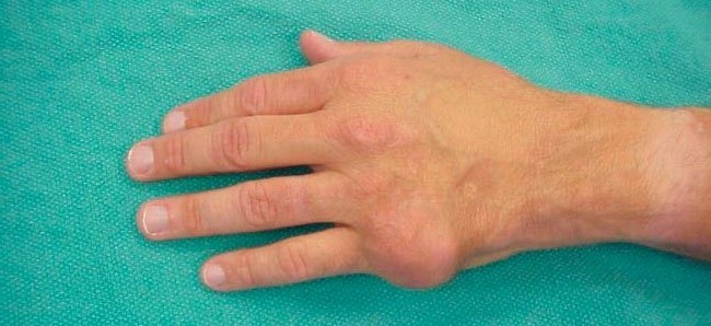 Воспаление сустава на руке