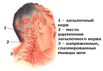 Симптомы невралгии проявляются в виде сильной боли в области шеи