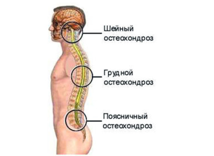  Остеохондроз шейного отдела имеет несколько позиций