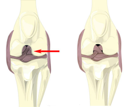 Разрыв передней крестообразной связки коленного сустава