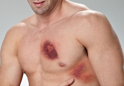ДТП или удар в грудь может привести к травме ребер