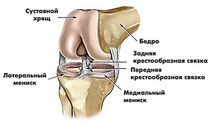 Повреждение мениска коленного сустава при остром и хроническом течении