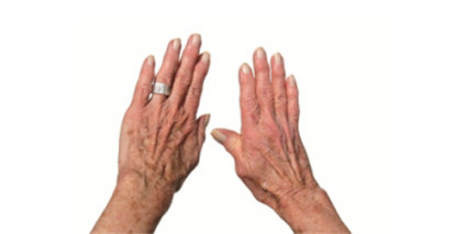 Что делать при остеоартрозе кистей рук