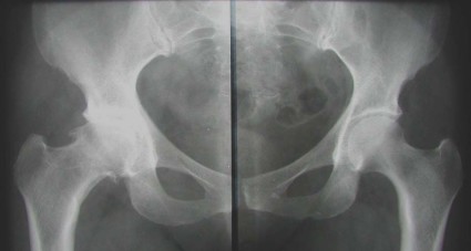 На основании рентгеновского снимка врачом отмечаются костные разрастания в районе хрящей