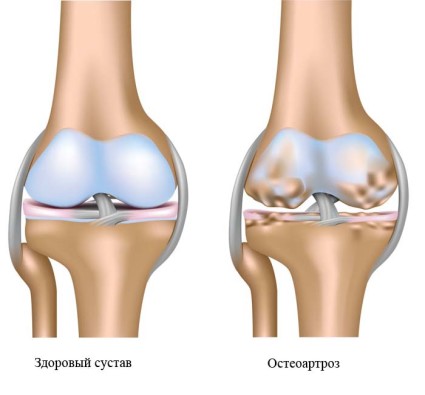 Остеоартроз коленного сустава 