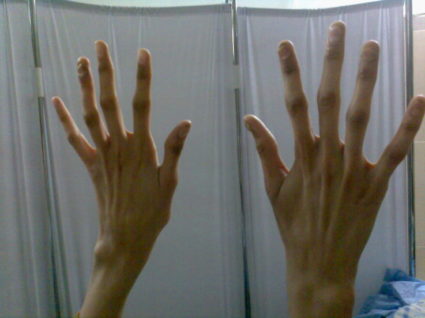 Паучья форма пальцев рук синдром thumbnail