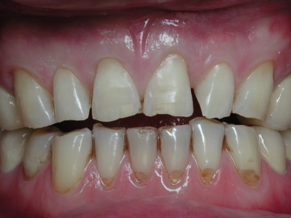 Заболевания зубов относятся к патологии, которая сопровождается разрушением костной ткани