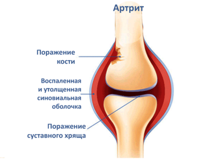 Поражённый артритом сустав