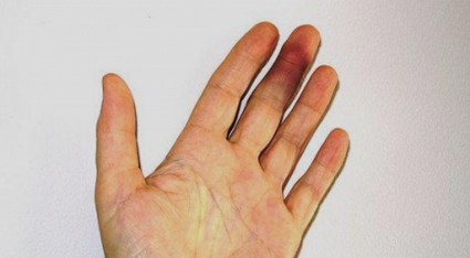 Травма пальца