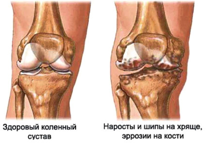 Гонартроз - называют деформирующим остеоартрозом обоих коленных суставов