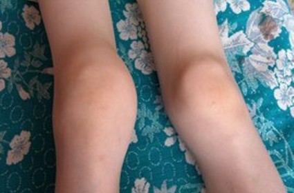 Симптомы характерны артрозу коленного сустава