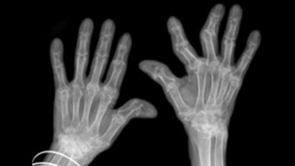 Рентген сможет определить наличие проблем с суставами