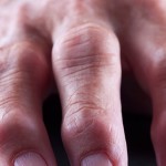 Фаланги пальцев, пораженные болезнью