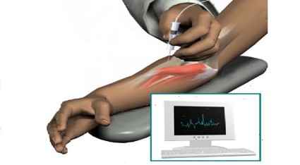Игольчатая электромиография,позволяет врачу определить, где находится очаг поражения