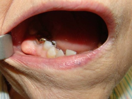 Иногда остеому в районе челюсти принимают за воспалительный процесс и рекомендуют удалить зуб